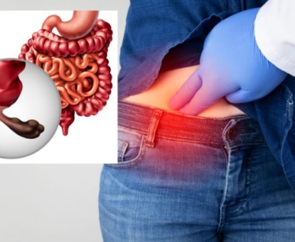 Biến chứng của viêm ruột thừa nếu không được điều trị kịp thời